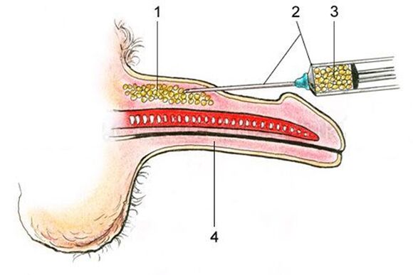リポフィリング - 陰茎のシャフトへの脂肪組織の導入